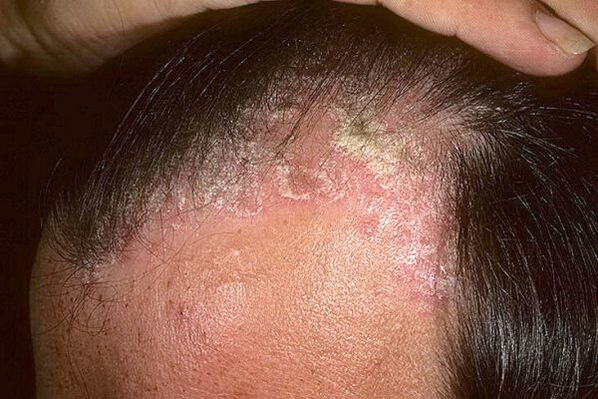 Symptoms of psoriasis