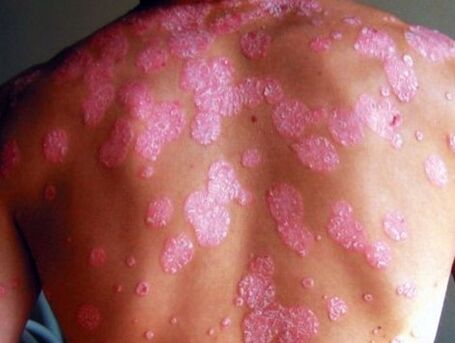 Psoriathic disease