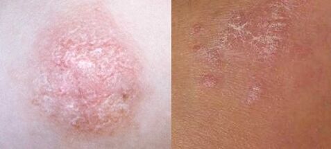 Psoriasis in the initial phase